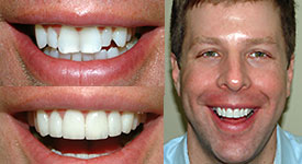 Dental-implants-north-york-toronto